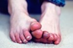 پای مردابی چگونه ایجاد و درمان می شود؟