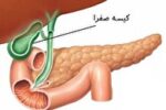 مشکلات گوارشی بعد از عمل کیسه صفرا