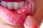 علت آفت زدن دهان چیست؟