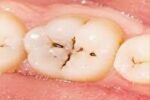 چرا پوسیدگی دندان ایرانیها زیاد است؟