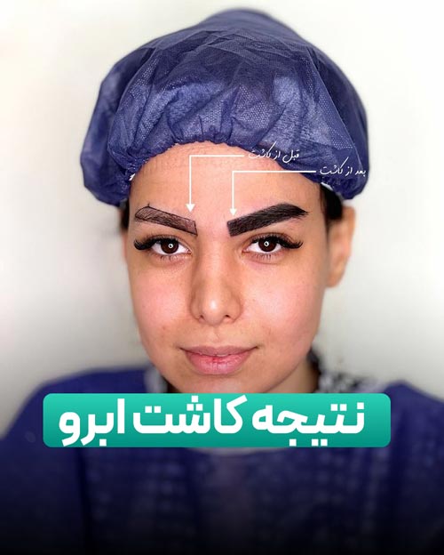 مراقبت‌های بعد از کاشت ابرو: از دوره‌های ابتدایی تا بهبودی کامل